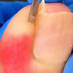 Ingrown nail solution
